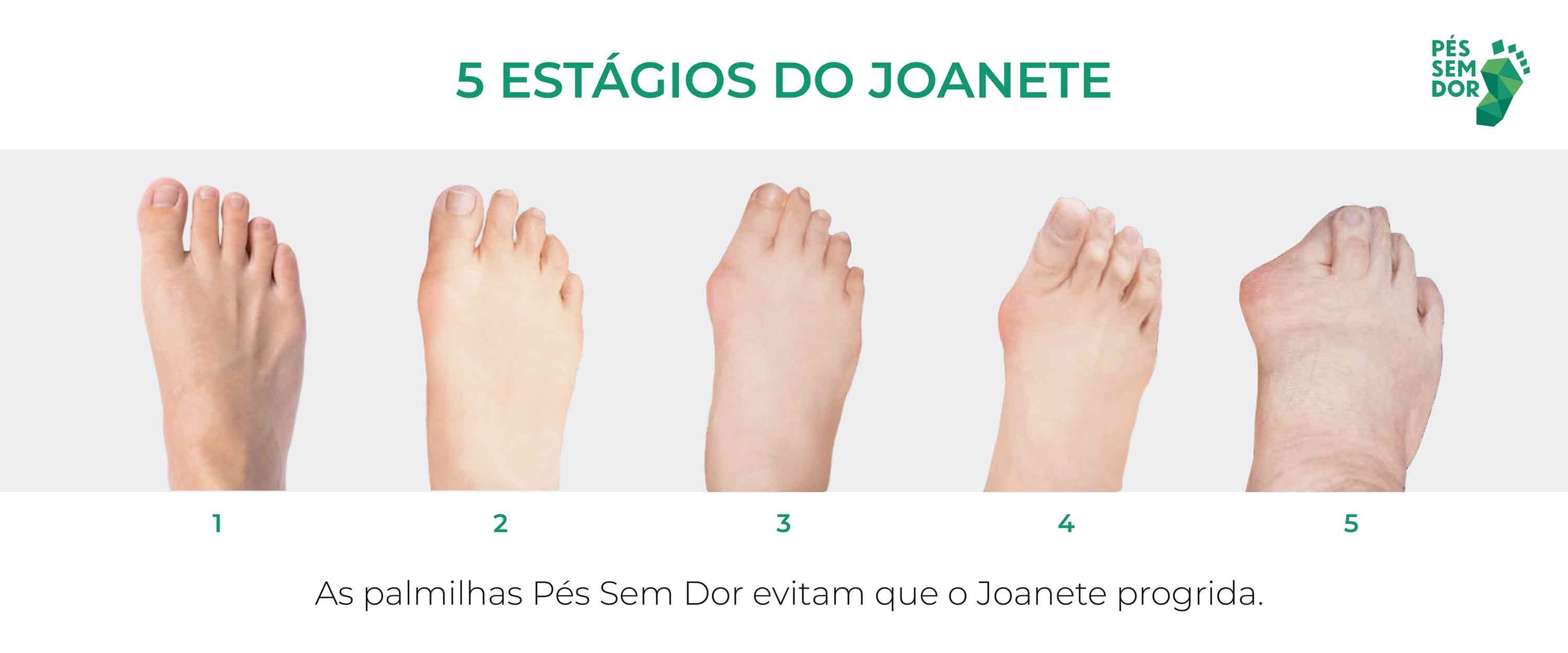 Imagem exemplificando os cinco estágios do joanete