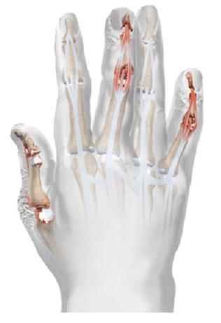 Artrite Psoriásica