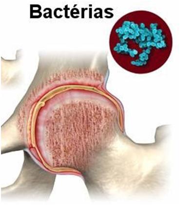 Artrite bacteriana