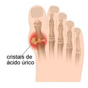 Articulação com gota