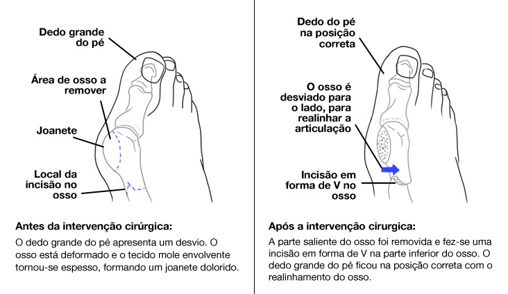 Opção cirúrgica para joanete