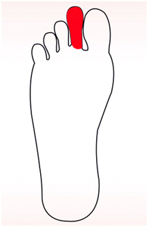 Ilustração de um pé com dedo de Morton