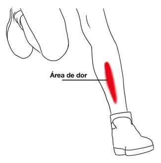 Imagem ilustrativa mostrando a área de dor relativa a canelite.