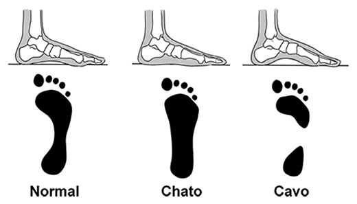 Imagem ilustrativa comparando o pé normal, pé chato e pé cavo.