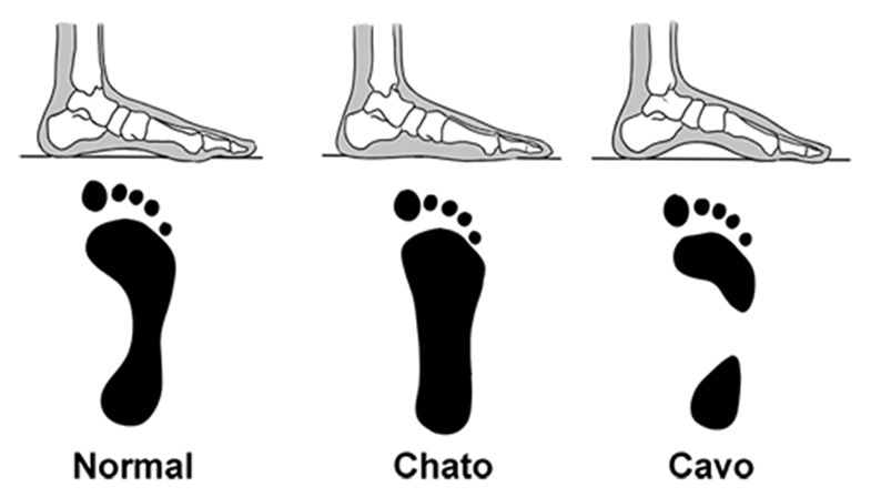 Comparação entre pé normal, pé chato e pé cavo.