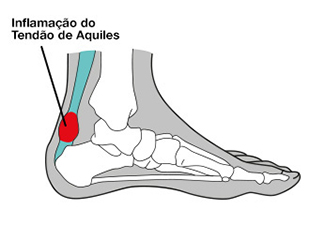 Inflamação no tendão de Aquiles.