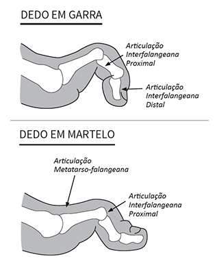 Dedo em garra e em martelo