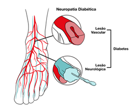 Neuropatia periférica